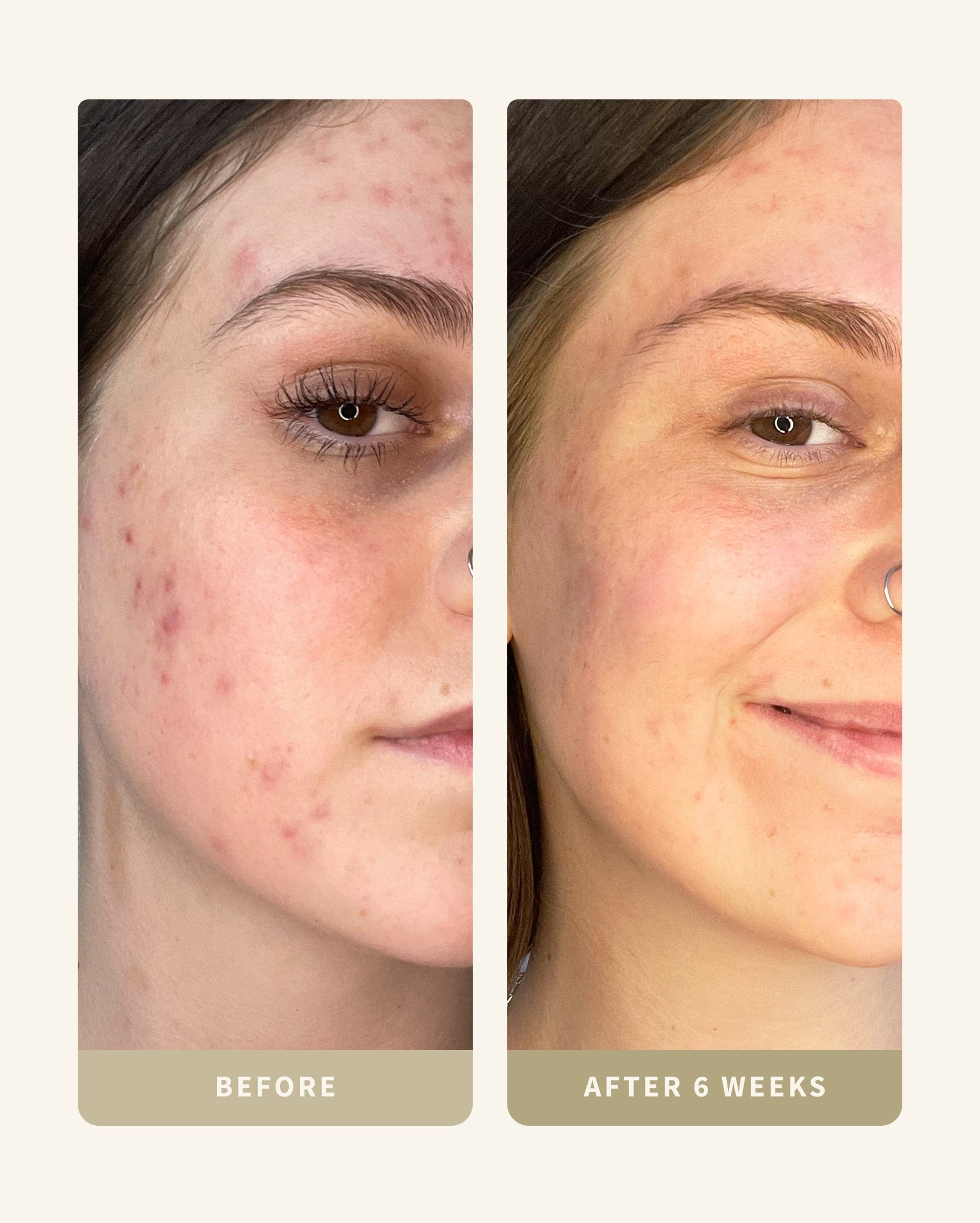 Oily Skin Kit