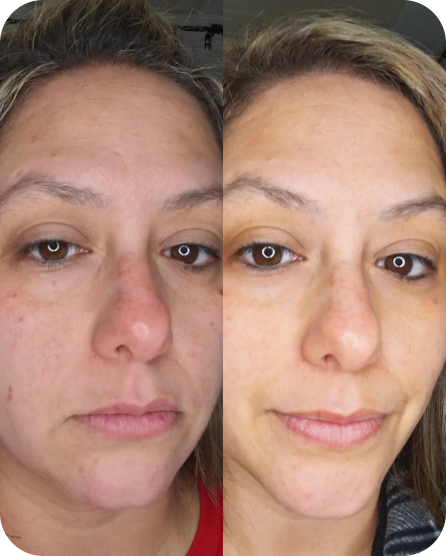 Heather B. before and after, 6 weeks of use