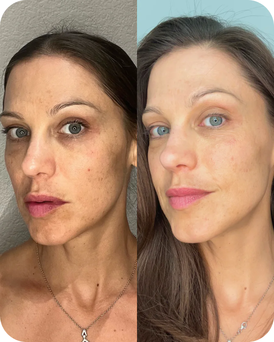 Jennifer B. before and after, 6 weeks of use