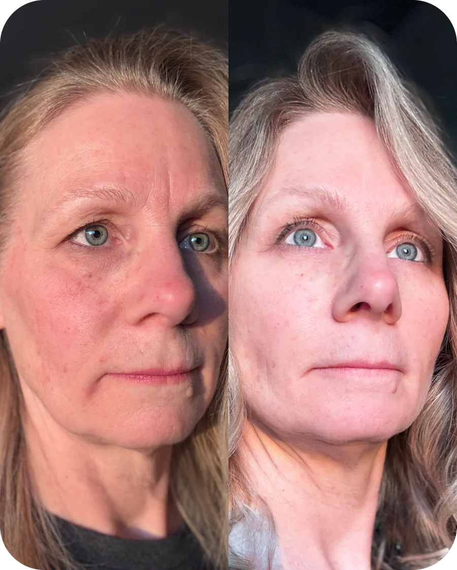 Lisa S. before and after, 6 weeks of use