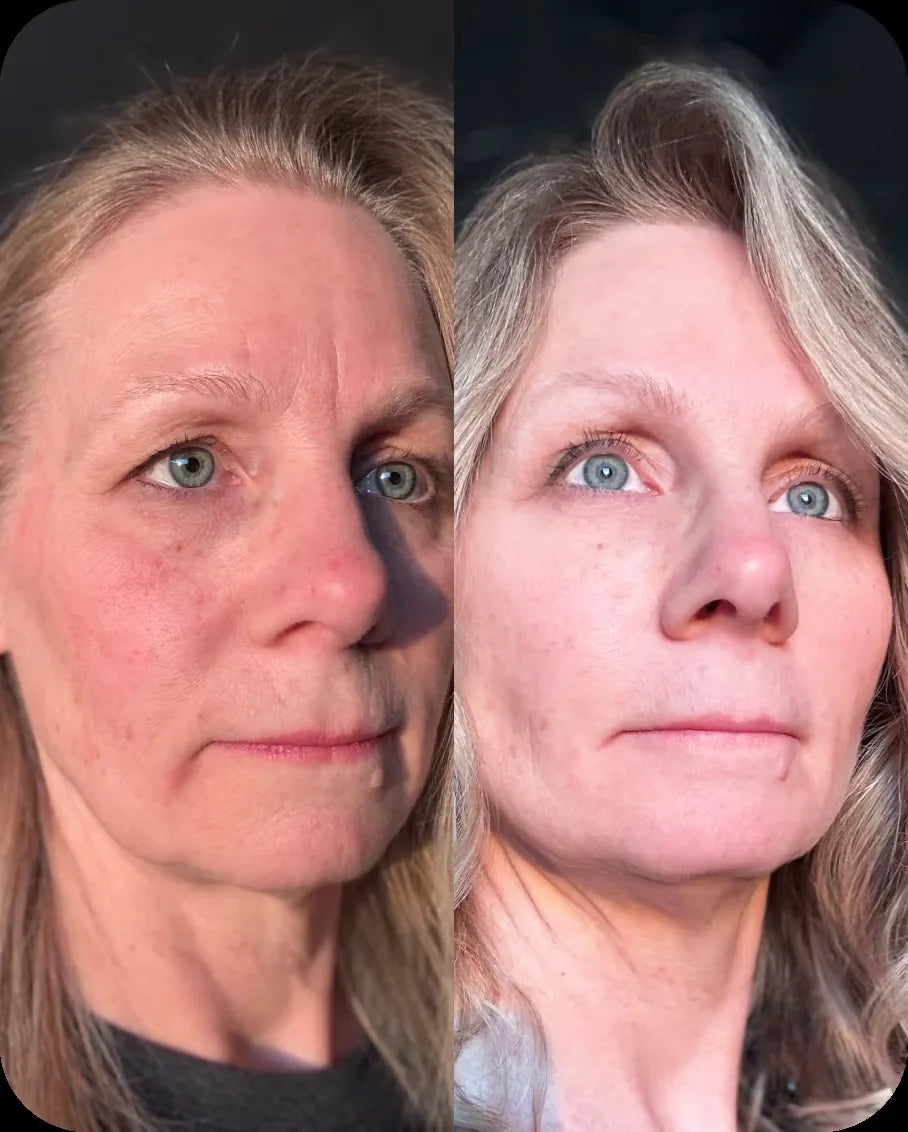 Lisa S. before and after, 6 weeks of use